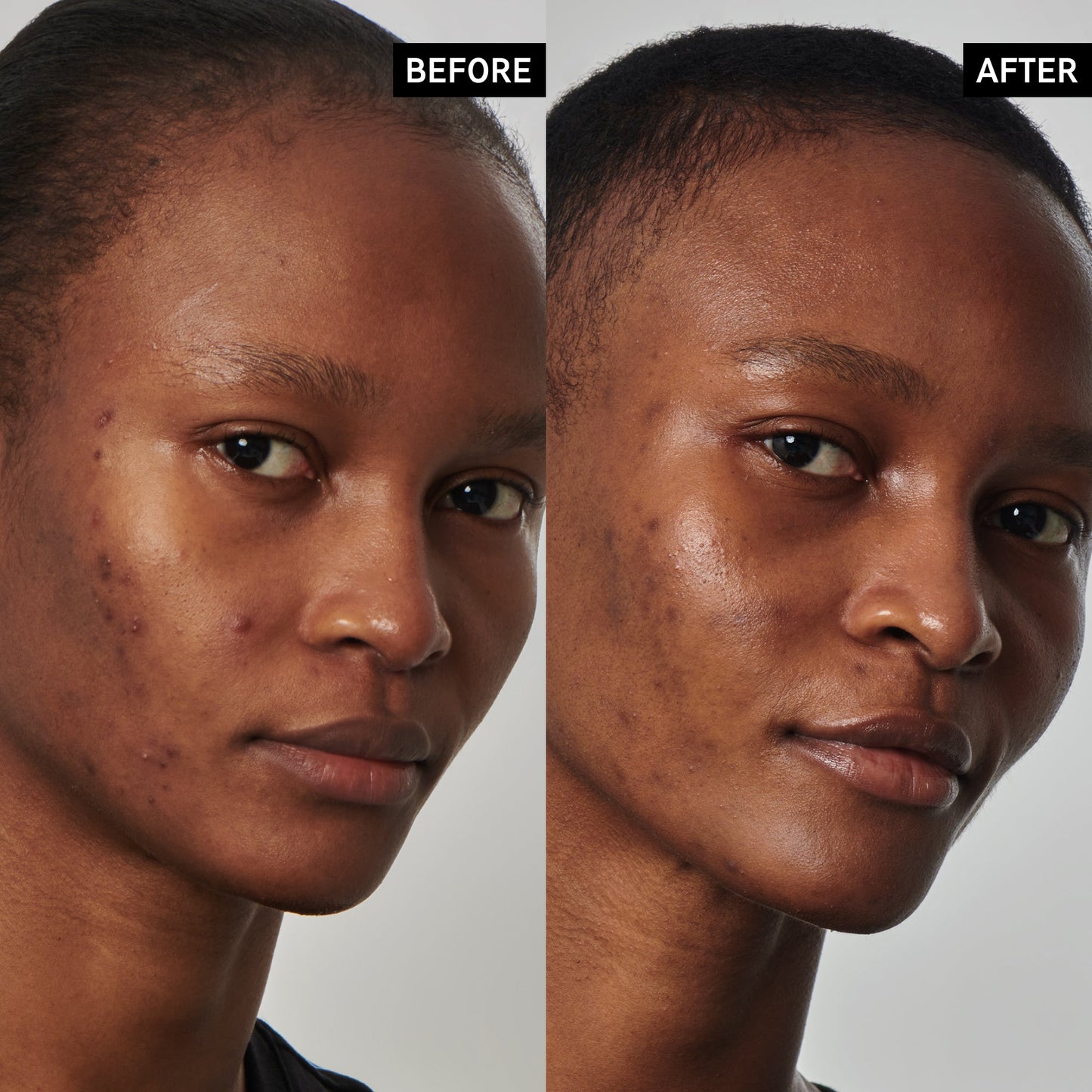 Inkey - 20% Niacinamide Serum